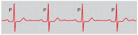 Khoảng P-R dài do block nhĩ thất độ 1 (đạo trình DII)