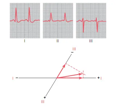 Phì đại thất trái gây lệch trục điện thế, phức bộ QRS kéo dài