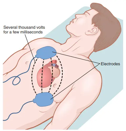 Shock điện điều trị rung thất