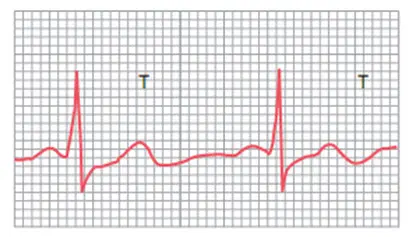 Sóng T hai đỉnh do ngộ độc digitalis