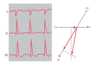 Trục lệch phải gây ra bởi block nhánh phải, phức bộ QRS kéo dài