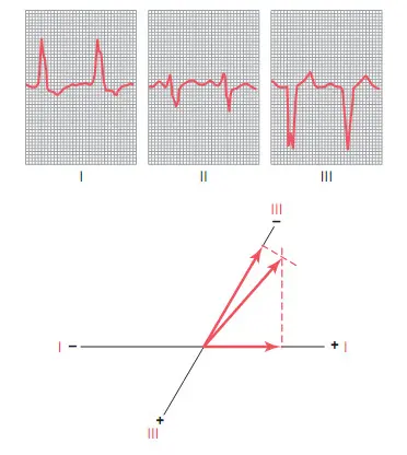 Trục lệch trái gây ra bởi block nhánh trái, phức bộ QRS kéo dài