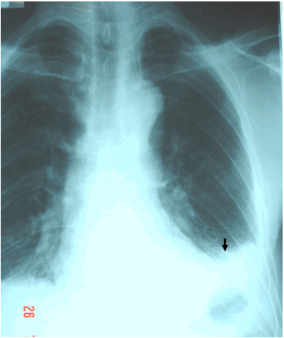 Hình ảnh tràn dịch màng phổi ít có góc sườn hoành trái tù