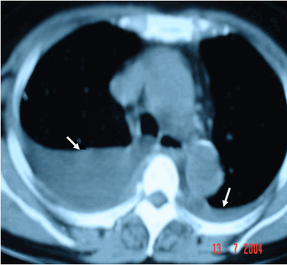 Hình ảnh tràn dịch màng phổi hai bên trên phim chụp cắt lớp ngực 
