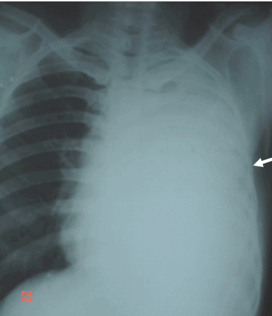 Hình ảnh tràn dịch màng phổi toàn bộ bên pbổi trái (các cơ quan trung thất bị đẩy hoàn toàn sang phải)