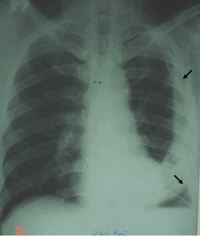 Tràn dịch màng phổi thể nách bên trái,  vòm hoành cùng bên bị kéo lên cao do dày dính & xẹp phổi kèm theo
