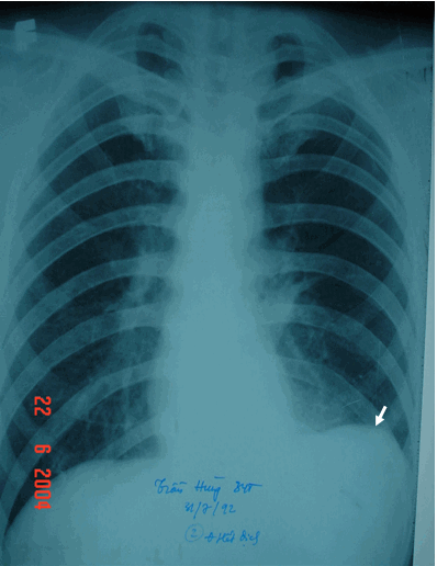 Tràn dịch màng phổi thể hoành bên trái (vòm hoành trái cao & đỉnh vòm hoành bị lệch ra 1/3 ngoài)