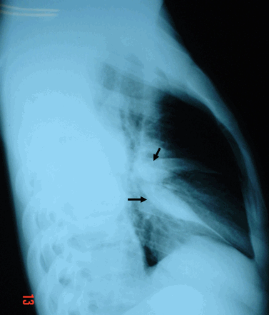 Hình ảnh tràn dịch màng phổi thể rãnh  liên thuỳ - Hình ảnh chiếc vợt (tràn dịch cả ở rãnh liên thuỳ bé & lớn)    TDMP thể rãnh liên thuỳ bé - ở mủi tên chỉ phái trên  TDMP thể rãnh liên thuỳ lớn - ở mủi tên chỉ phái dưới