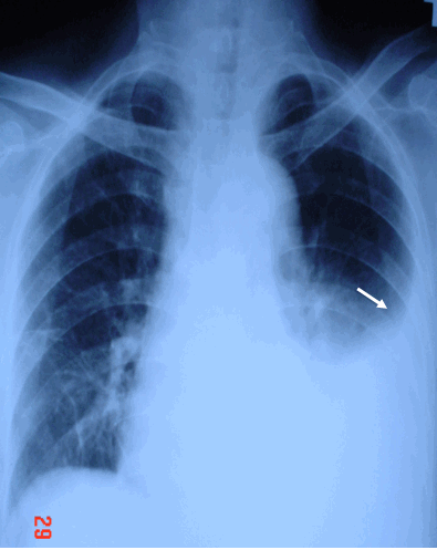 Hình ảnh đường cong Damoiseau trong tràn dịch màng phổi trên phim chụp phổi thẳng, tim bị đẩy nhẹ sang bên phải ở bệnh nhân nữ, 80 tuổi - Tràn dịch màng phổi trái