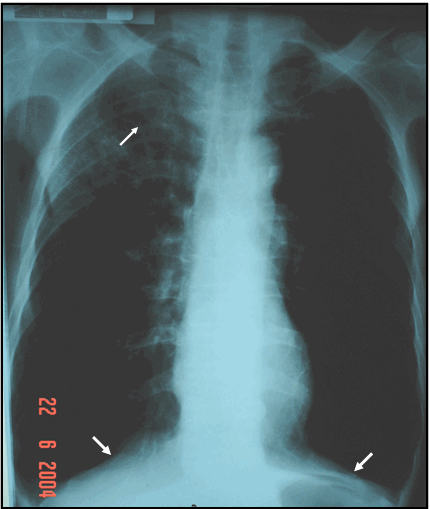 Hình ảnh giãn phế nang toàn bộ hai phổi, hoành hai bên bị đẩy xuống & có hình dốc lên kiểu  mái nhà, vùng đỉnh phổi & hạ đòn phải kém sáng – Hình chẩn đoán phân biệt với tràn khí màng phổi