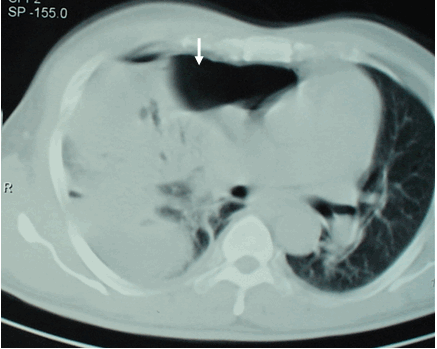 Hình ảnh tràn mủ tràn khí màng phổi trên phim chụp cắt lớp ngực ở cửa sổ nhu mô (cùng bệnh nhân)