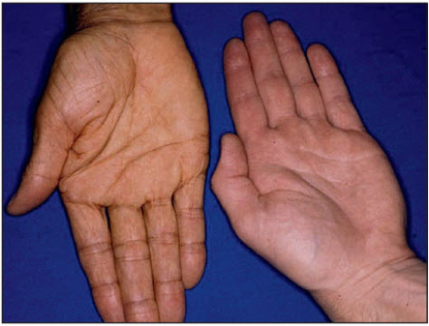 Lắng đọng carotene da (trái) và bàn tay bình thường (phải)