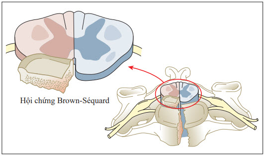 Biểu đồ tổn thương gây ra hội chứng Brown