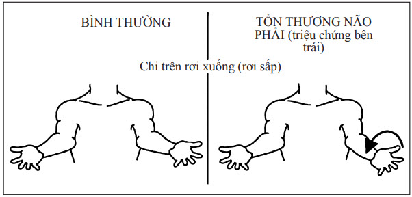 Cánh tay rơi sấp