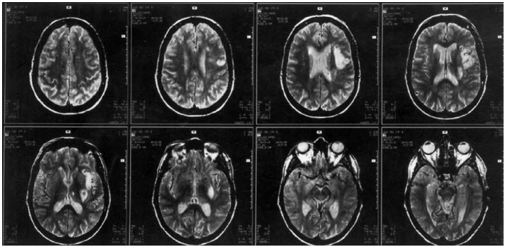 Hình ảnh MRI của bệnh nhân bị thất ngôn Broca do nhồi máu vùng Broca