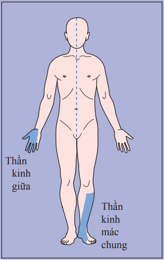 Mất cảm giác theo sự phân vùng thần kinh ngoại biên