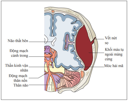 Minh họa khối máu tụ ngoài màng cứng