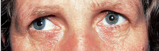 Nhìn sang phải với mắt trái liệt nhìn trong ở một bệnh nhân liệt vận nhãn liên nhân