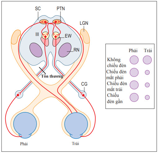 Phản xạ đồng tử với liệt vận nhãn