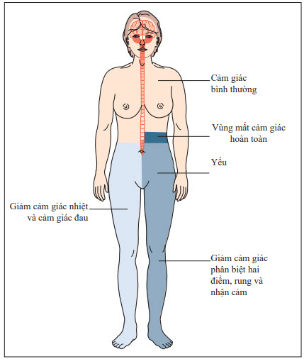 Sự phân bố của biểu hiện cảm giác và vận động trong cắt ngang tủy bên trái