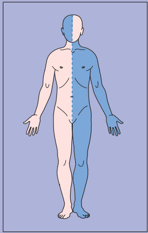 Cơ chế gây yếu cơ dựa trên các kiểu dấu hiệu lâm sàng mặt một bên và chân tay đối bên
