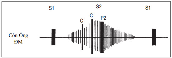 Thời gian và hình dạng của âm thổi còn ống động mạch