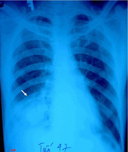 Hình ảnh đám mờ đáy phổi phải trên phim phổi thường ở bệnh nhân nam, 47 tuổi - Ung thu phổi áp xe hóa