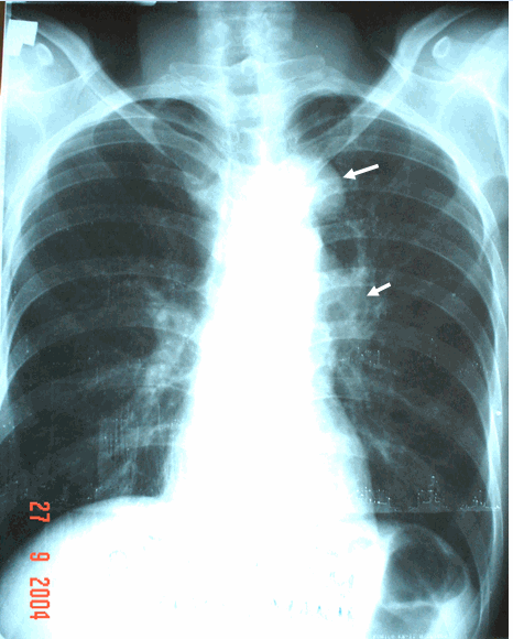 Hình ảnh u phổi (mũi tên trên cùng) trong hội chứng Pierre Marie. Hình ảnh hạch trung thất to (mũi tên phía dưới) ở bệnh nhân nam, 61 tuổi - Hội chứng Pierre Marie