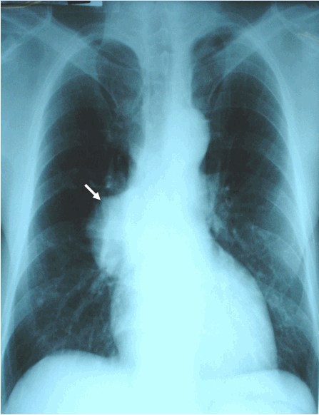 Hình ảnh K phổi phải thể ngoại vi