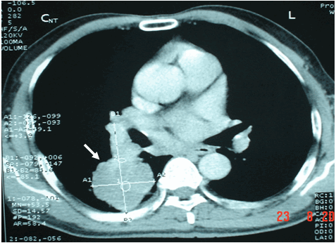 Hình ảnh k phổi thể ngoại vi
