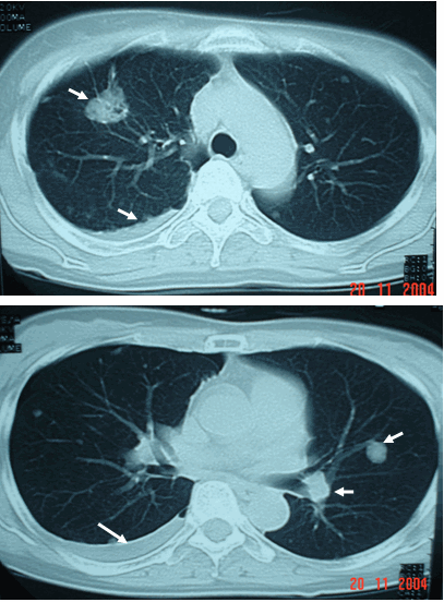 Hình ảnh ung thư phổi thứ phát kiểu thả bóng