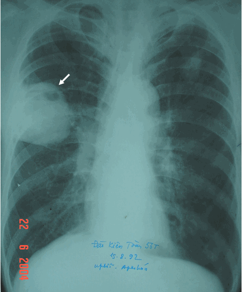 Hình ảnh ung thư phổi phải áp xe hoá ( u phổi thể ngoại vi)