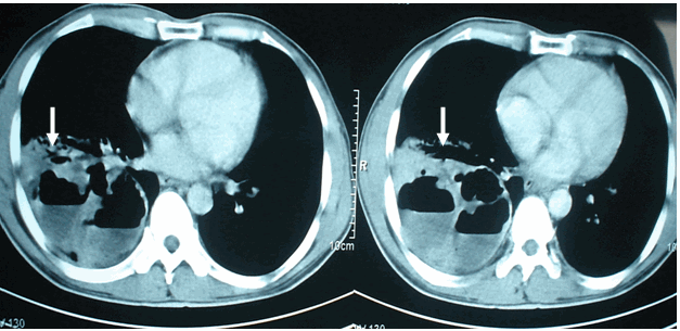 Hình ảnh u phổi áp xe hóa nhiều ổ có mức nước mức hơi được phát hiện trên phim chụp cắt lớp vi tính mà trên phim phổi thường không phát hiện được ở cùng bệnh nhân nam, 47 tuổi - Ung thu phổi áp xe hoá