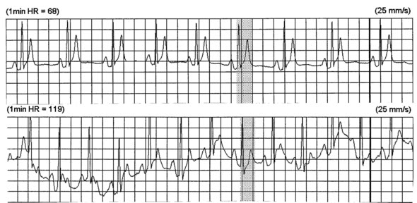 Dải Holter từ một bệnh nhân SQTS