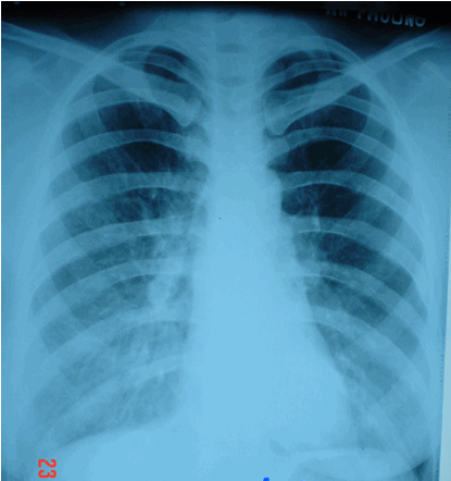 Viêm phổi điển hình. Hình ảnh mờ đáy phổi hai bên do viêm phổi