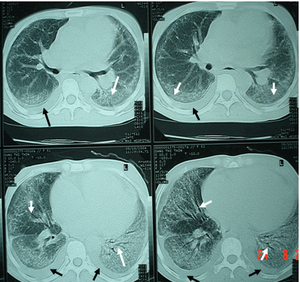 Hình ảnh tràn dịch màng phổi (mũi tên đen)  &  hình ảnh kính mài - hội chứng đông đặc với các phế quản hơi (mũi tên trắng) trong viêm phổi kẽ được phát hiện trên phim chụp cắt lớp lồng ngực có độ phân giải cao 